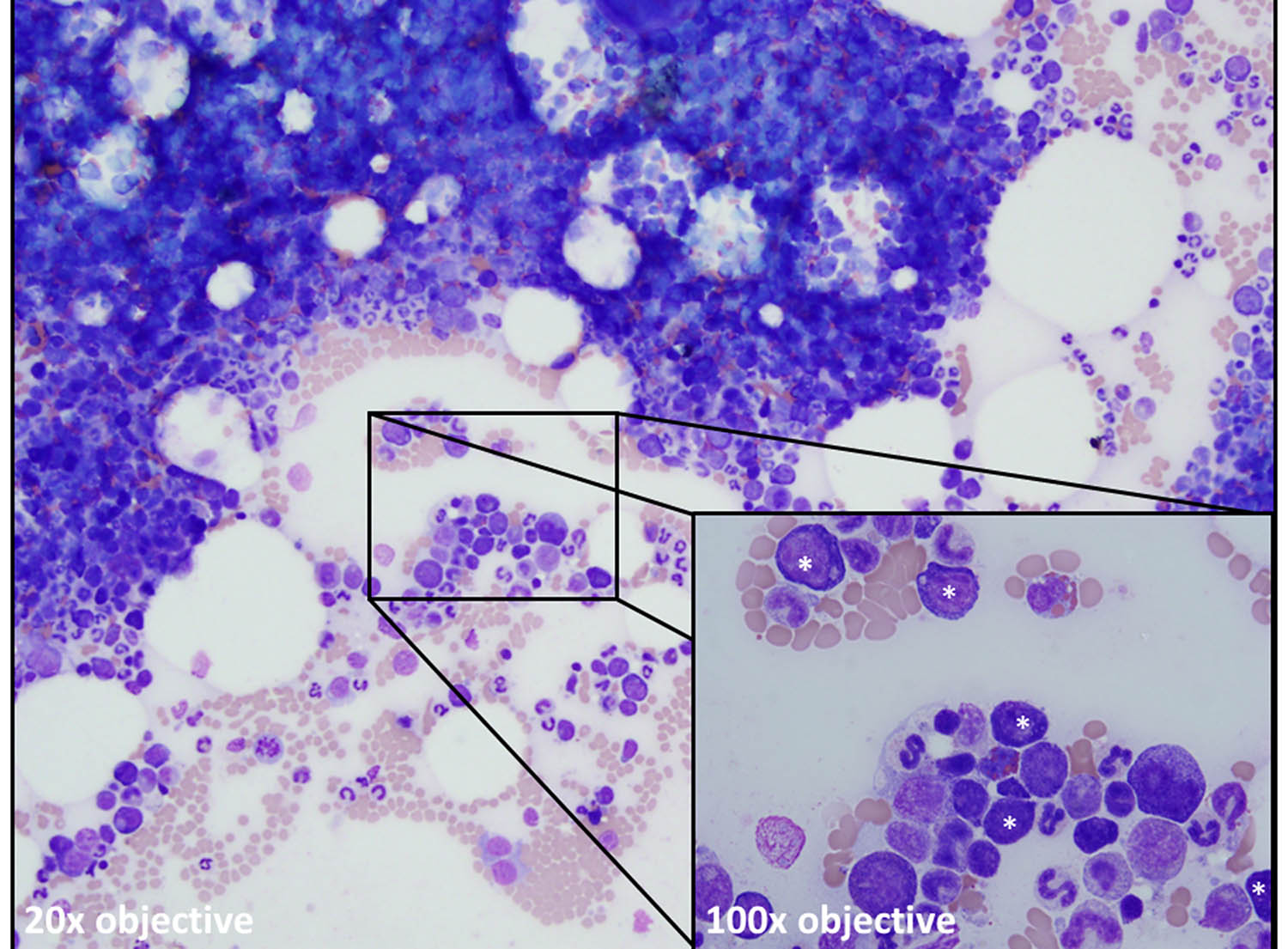 Demystifying Bone Marrow Evaluation 