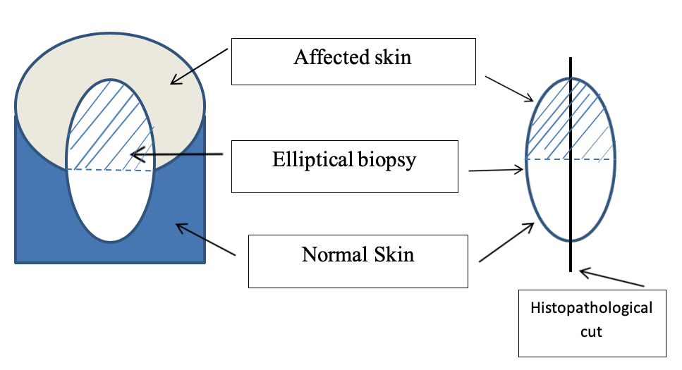 Incisional elliptical biopsy 
