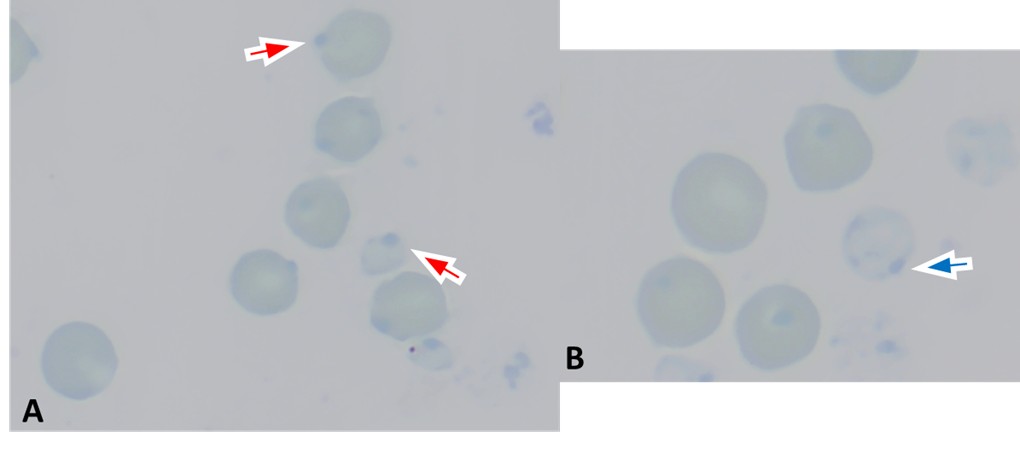Two-panel micrograph of a new methylene blue–stained blood smear from a sheep with oxidative hemolytic anemia. Heinz bodies appear as dark blue round inclusions within intact erythrocytes (Panel A, red arrows) and a ghost erythrocyte (Panel B, blue arrow).