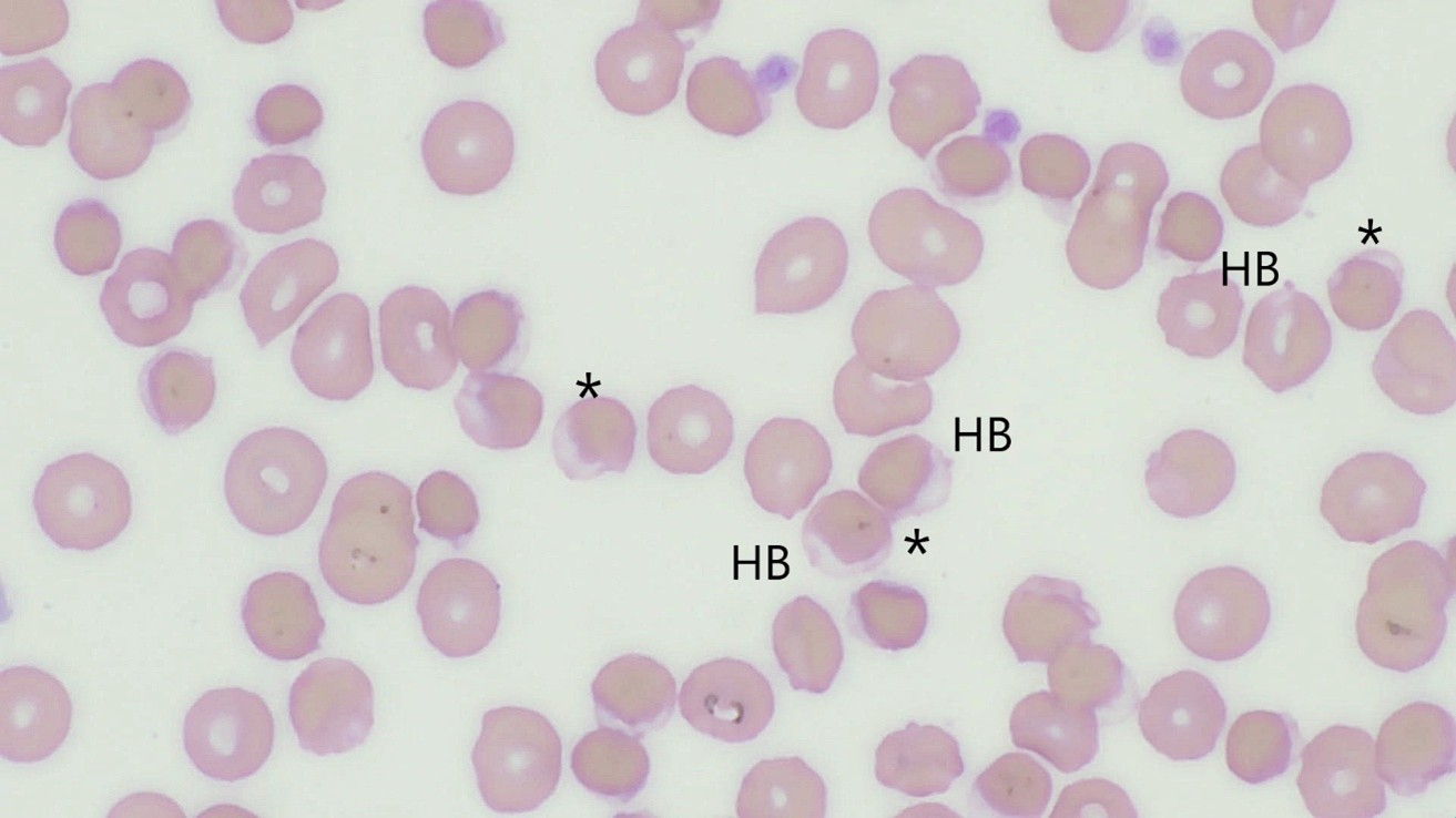 Wright-Giemsa–stained blood smear of a dog with oxidative hemolytic anemia. Asterisks mark eccentrocytes with hemoglobin shifted to one side of the red blood cell, while “HB” labels identify small Heinz bodies.
